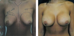 Breast Augmentation Patient Before & After Photo 1