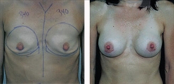 Breast Augmentation Patient Before & After Photo 1