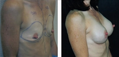 Breast Augmentation Patient Before & After Photo 1