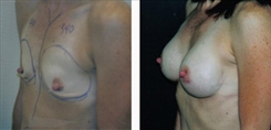 Breast Augmentation Patient Before & After Photo 1