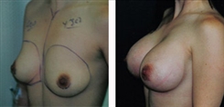 Breast Augmentation Patient Before & After Photo 1