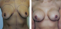 Breast Augmentation Patient Before & After Photo 1