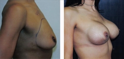 Breast Augmentation Patient Before & After Photo 1