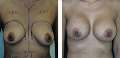 Breast Augmentation Patient Before & After Photo 1