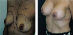 Breast Augmentation Patient Before & After Photo 1