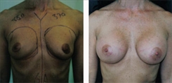 Breast Augmentation Patient Before & After Photo 1