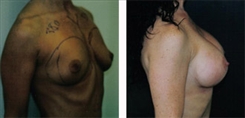 Breast Augmentation Patient Before & After Photo 1