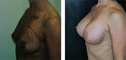 Breast Augmentation Patient Before & After Photo 1