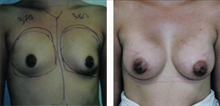 Breast Augmentation Patient Before & After Photo 1