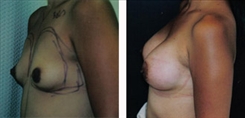 Breast Augmentation Patient Before & After Photo 1