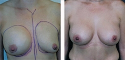 Breast Augmentation Patient Before & After Photo 1