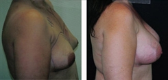 Breast Augmentation Patient Before & After Photo 1