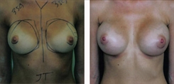 Breast Augmentation Patient Before & After Photo 1