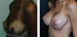 Breast Augmentation Patient Before & After Photo 1