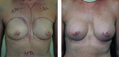 Breast Augmentation Patient Before & After Photo 1