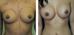 Breast Augmentation Patient Before & After Photo 1