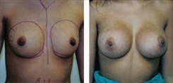 Breast Augmentation Patient Before & After Photo 1