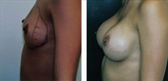 Breast Augmentation Patient Before & After Photo 1