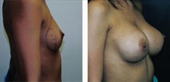 Breast Augmentation Patient Before & After Photo 1