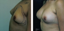 Breast Augmentation Patient Before & After Photo 1