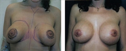 Breast Augmentation Patient Before & After Photo 1