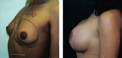 Breast Augmentation Patient Before & After Photo 1