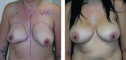 Breast Augmentation Patient Before & After Photo 1