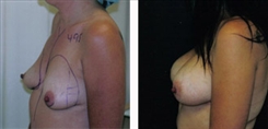 Breast Augmentation Patient Before & After Photo 1