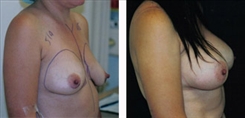 Breast Augmentation Patient Before & After Photo 1