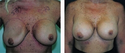 Breast Augmentation Patient Before & After Photo 1