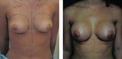 Breast Augmentation Patient Before & After Photo 1