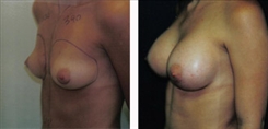 Breast Augmentation Patient Before & After Photo 1