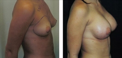 Breast Augmentation Patient Before & After Photo 1