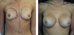 Breast Augmentation Patient Before & After Photo 1