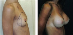 Breast Augmentation Patient Before & After Photo 1