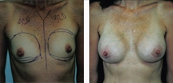 Breast Augmentation Patient Before & After Photo 1