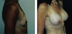 Breast Augmentation Patient Before & After Photo 1