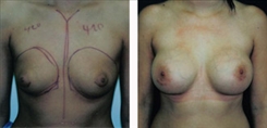 Breast Augmentation Patient Before & After Photo 1