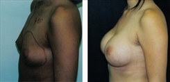 Breast Augmentation Patient Before & After Photo 1