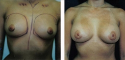 Breast Augmentation Patient Before & After Photo 1