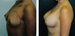 Breast Augmentation Patient Before & After Photo 1