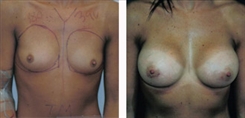 Breast Augmentation Patient Before & After Photo 1