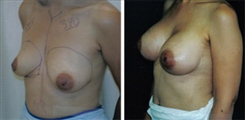 Breast Augmentation Patient Before & After Photo 1