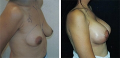 Breast Augmentation Patient Before & After Photo 1