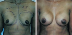 Breast Augmentation Patient Before & After Photo 1