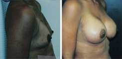 Breast Augmentation Patient Before & After Photo 1