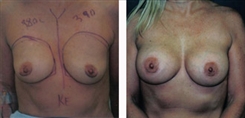 Breast Augmentation Patient Before & After Photo 1