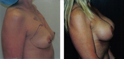 Breast Augmentation Patient Before & After Photo 1