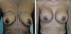 Breast Augmentation Patient Before & After Photo 1