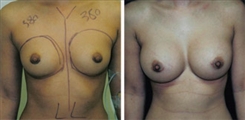 Breast Augmentation Patient Before & After Photo 1